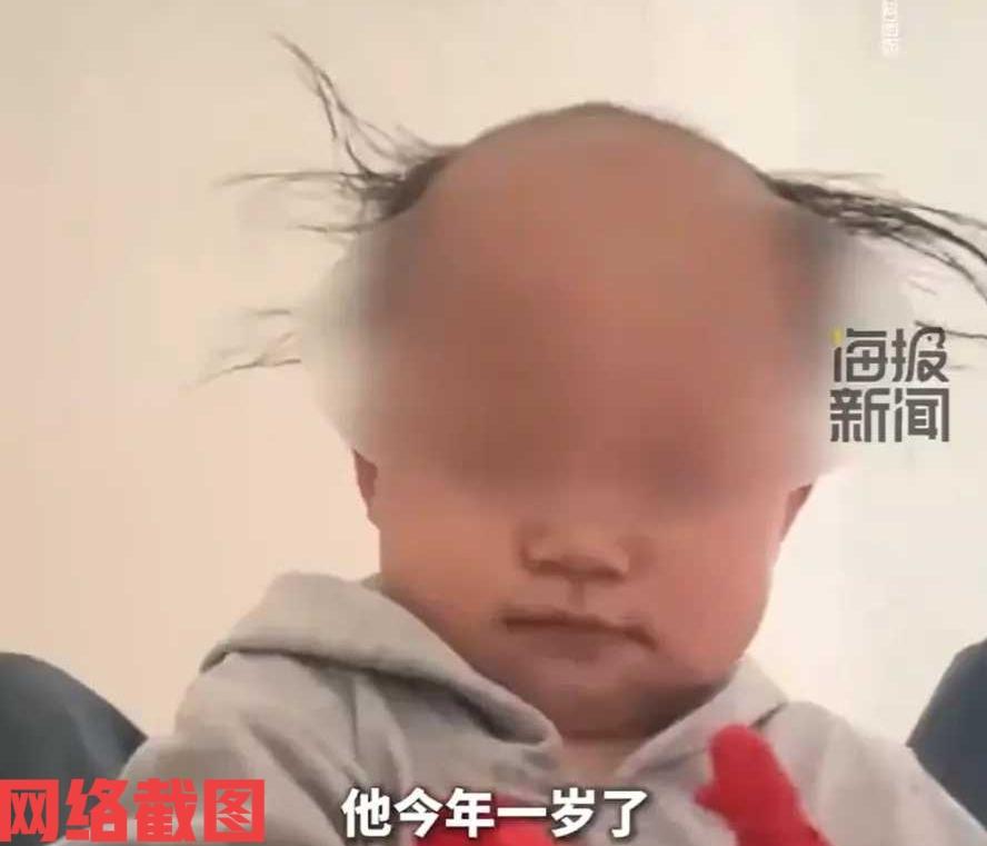 贵州毕节有一岁男孩前额就开始秃了。为此家里的妈妈还特意带孩子去医院检查，医生