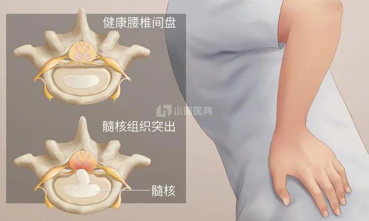 《腰椎间盘突出：不吃药、不打针，只需做好两件事就能痊愈，你相信吗？》两年前，