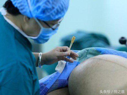 孕29周孕妇, 产检时医生建议立即手术, 剖开肚子后医生吓了一跳