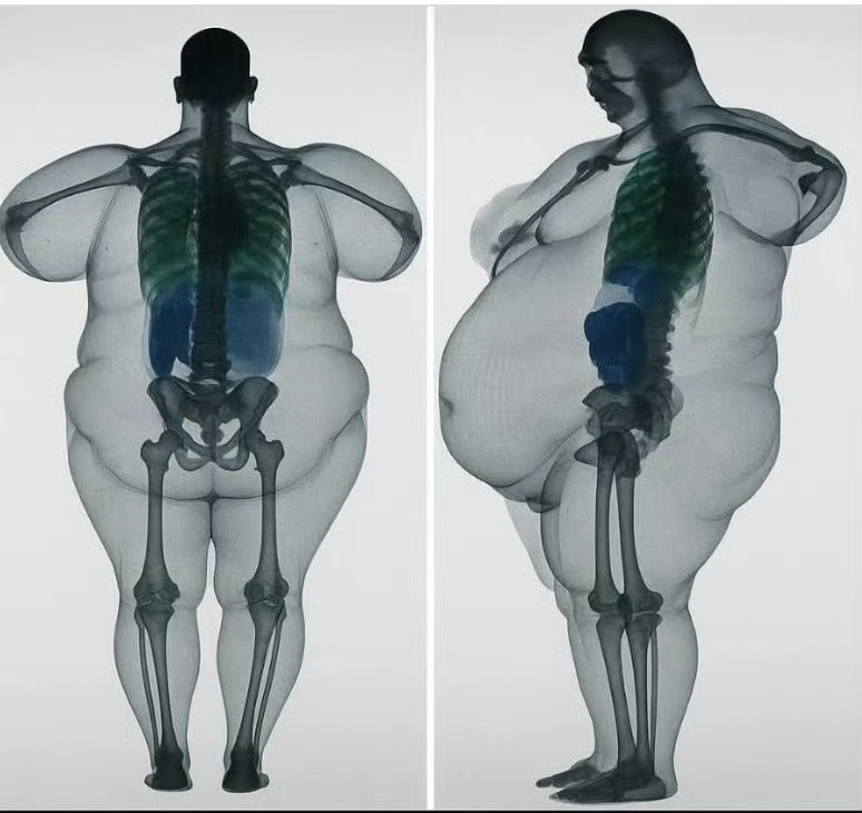 瘦人和胖人的骨骼一样，但脂肪量可不一样。还不快点减肥？