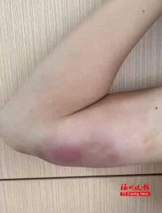 “悲剧还是发生了！”福建福州，一13岁男孩多次对流浪猫进行投喂，结果手臂上突然长