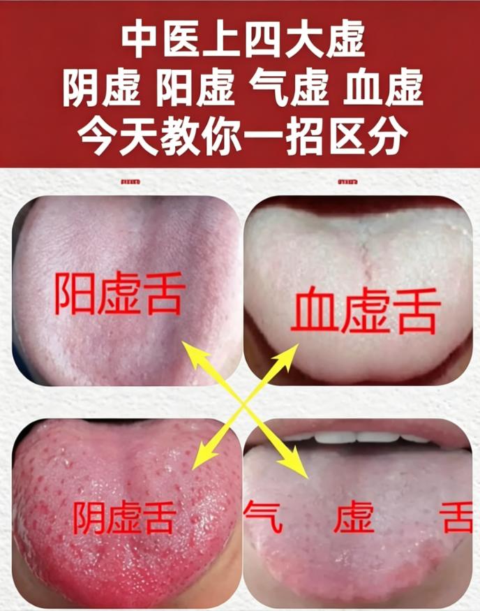 阴虚、阳虚、气虚、血虚，一张舌象图教你分清四大虚