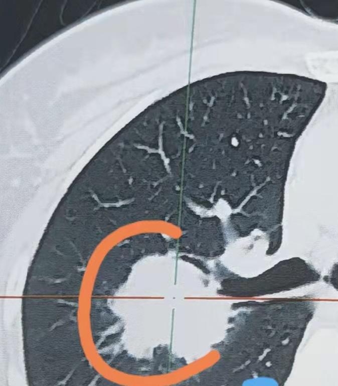戒烟不到2年，为什么还是得了肺癌？前阵子，一位有着20多年烟龄的老朋友，一脸困惑