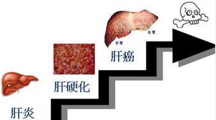 如果你脸上、身上有这些症状, 要注意这是肝硬化在找你麻烦!