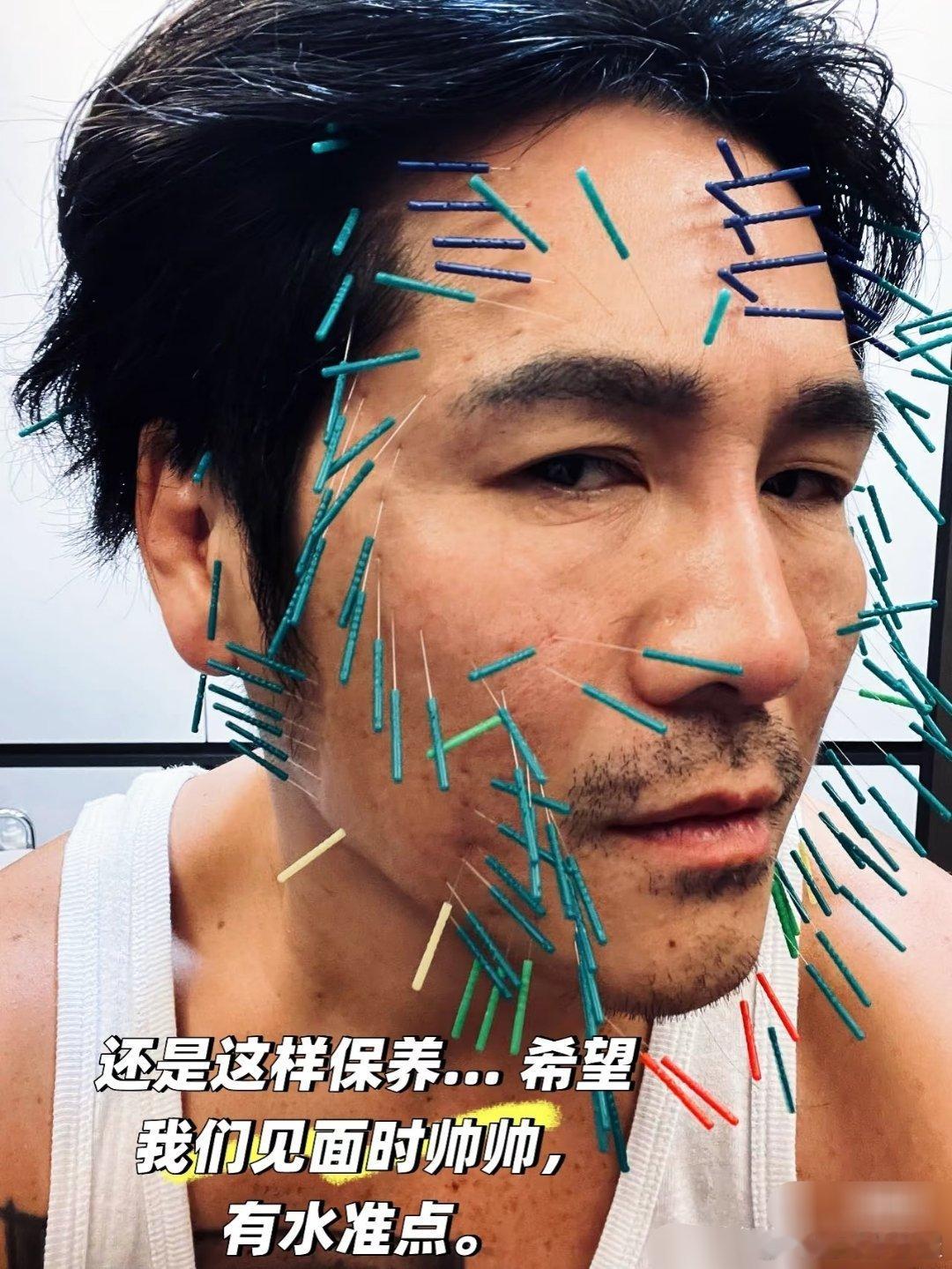 明星为啥都这么爱做全脸针灸[惊恐]曹格也做了陈乔恩同款​​​
