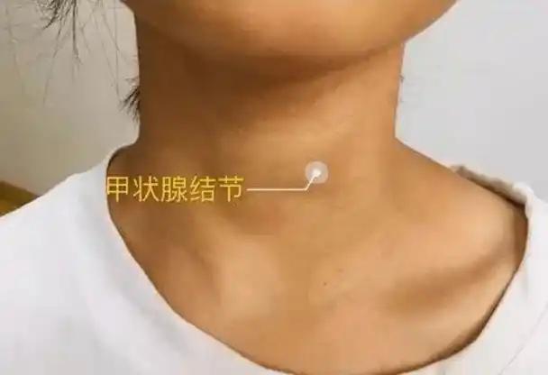 我有个发小叫林晓，30岁不到就做到公司中层，前阵子却在体检中心哭成了泪人。 