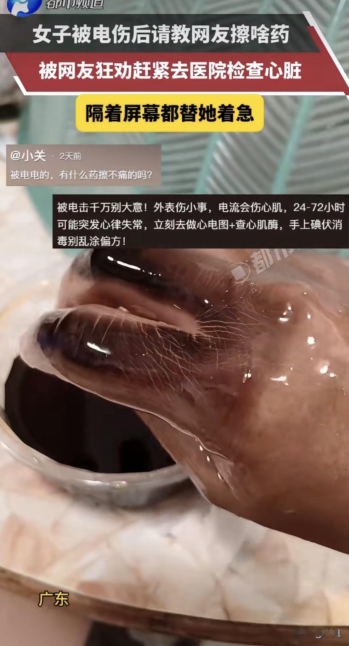 广东一个姑娘，手背被电伤了。她掏出手机拍了条视频，没喊疼，没叫人，开口问的是：擦
