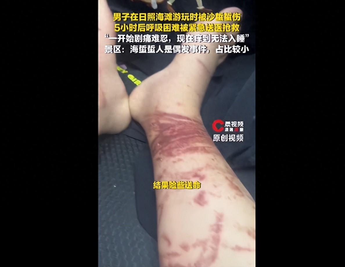 山东日照男子陈先生下海游泳，浅水区被沙蛰（大型水母）蜇伤，未及时就医，硬扛四五小