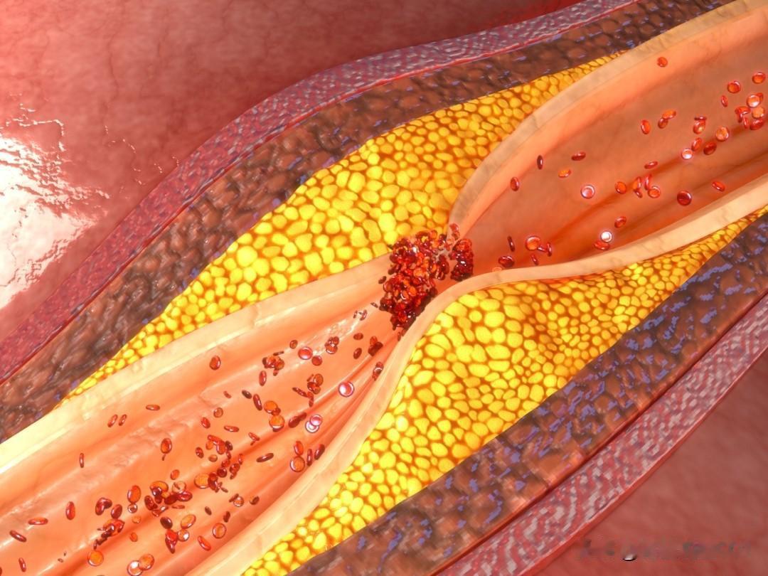 体检查出血管斑块？4种中成药帮你稳斑块、降风险，聊聊天就懂！是不是体检一看