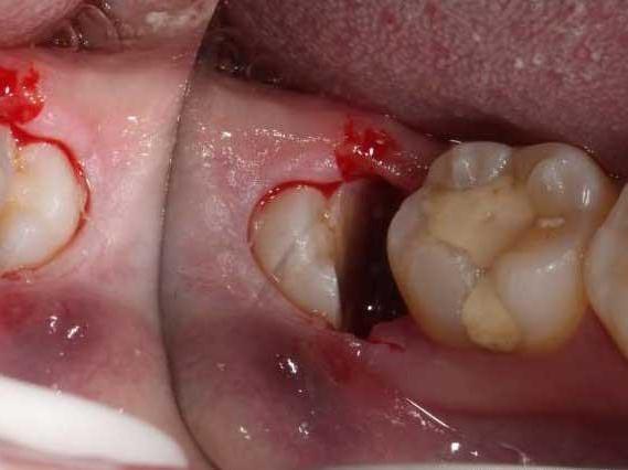 干槽症是因为口腔细菌引起牙槽窝内的骨创感染所致,如果拔完智齿3~4天