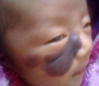 宝宝出生满脸胎记都是孕妇怀孕期间坏习惯惹的祸, 孕期需注意