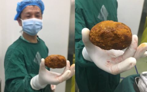 老人腹痛如刀绞, 胆管中取出“红薯”般大结石