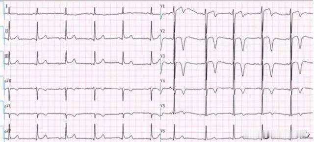 心脏超声怀疑冠心病实际不一定。上周末在门诊碰到这样一例患者。65岁女性，在家干农