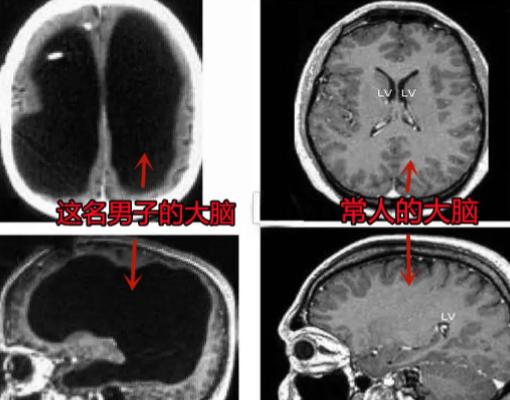 2007年，法国出现了一个“无脑”人！原来一男子在做脑部检查时，竟然被发现他没有
