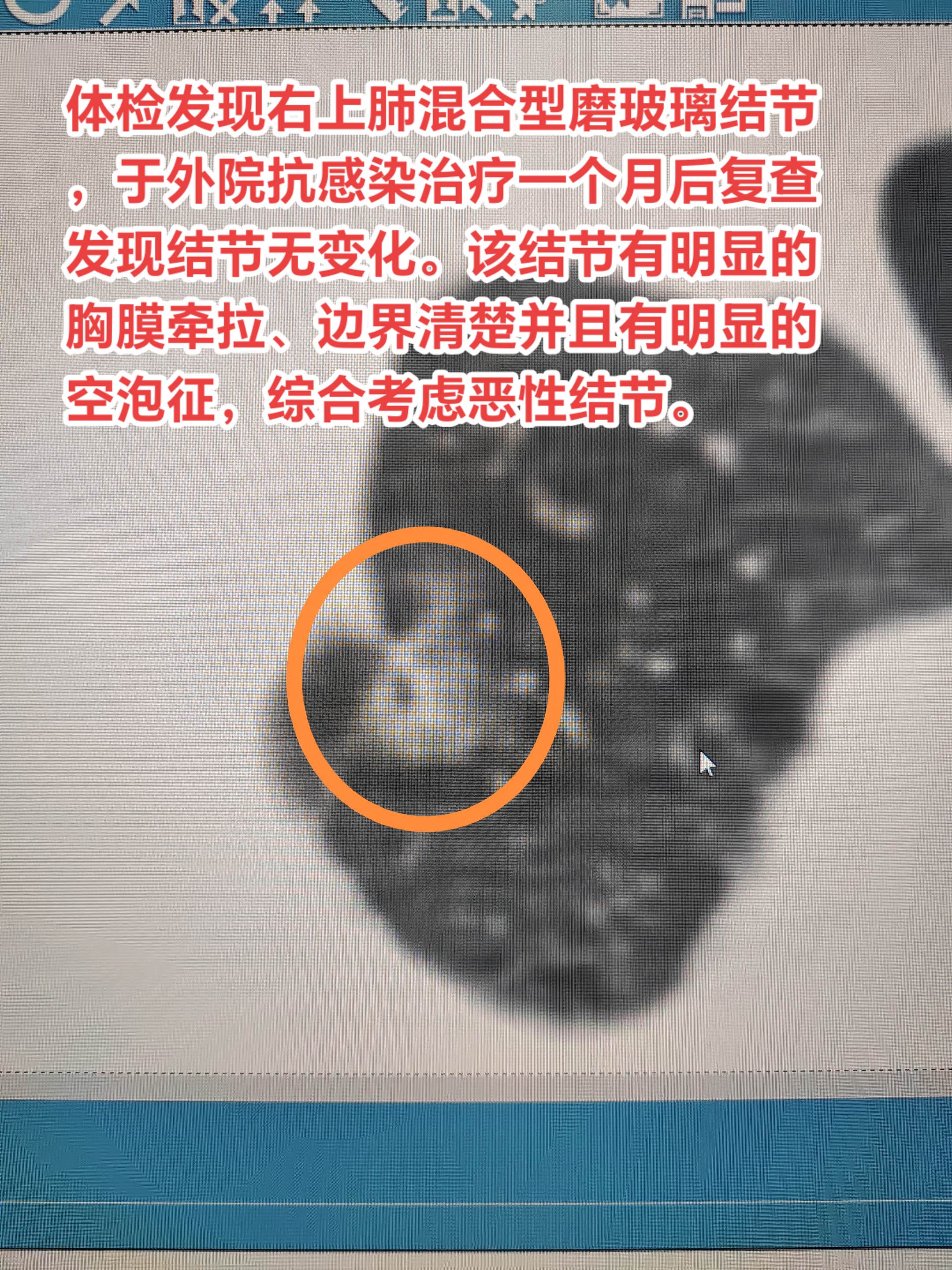 肿瘤性结节用中药及消炎药是无效的。体检发现右上肺混合型磨玻璃结节，于外...