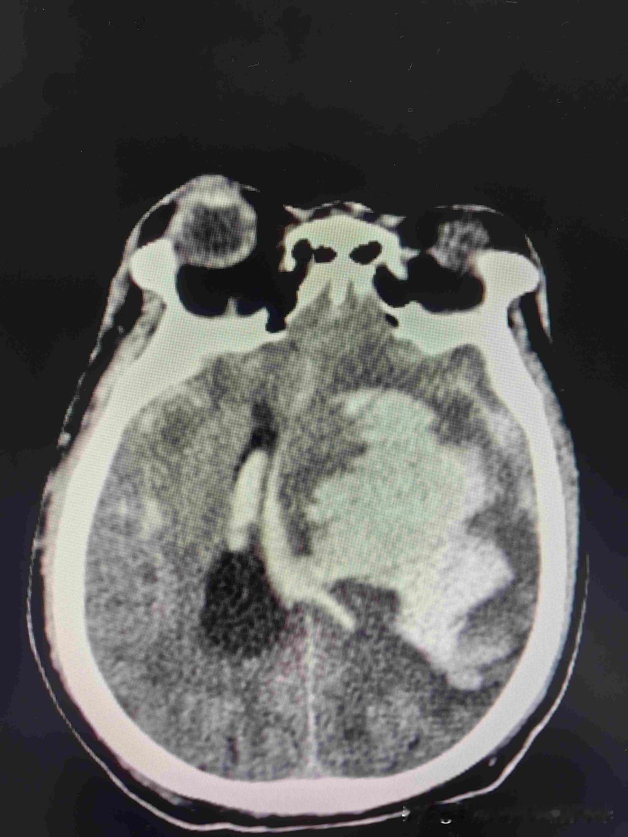 还有治疗的价值吗？前天晚上，张大哥照例跟朋友打牌，打到很晚，走的时候还笑着喊