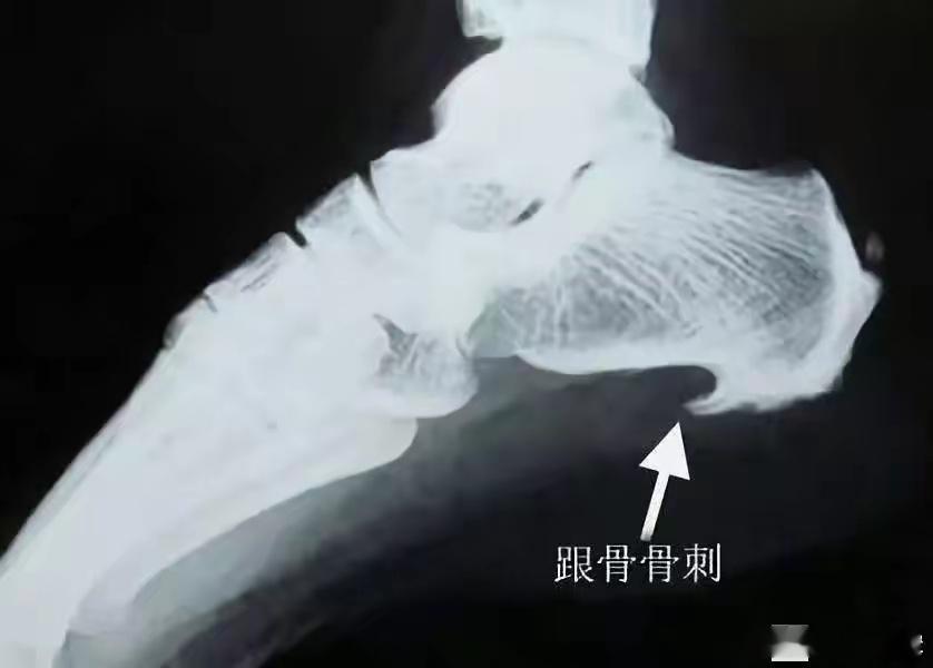 外治跟骨骨刺一绝太极本草外治跟骨骨刺一绝跟骨骨刺属祖国医学足跟痛范围，多见于中老