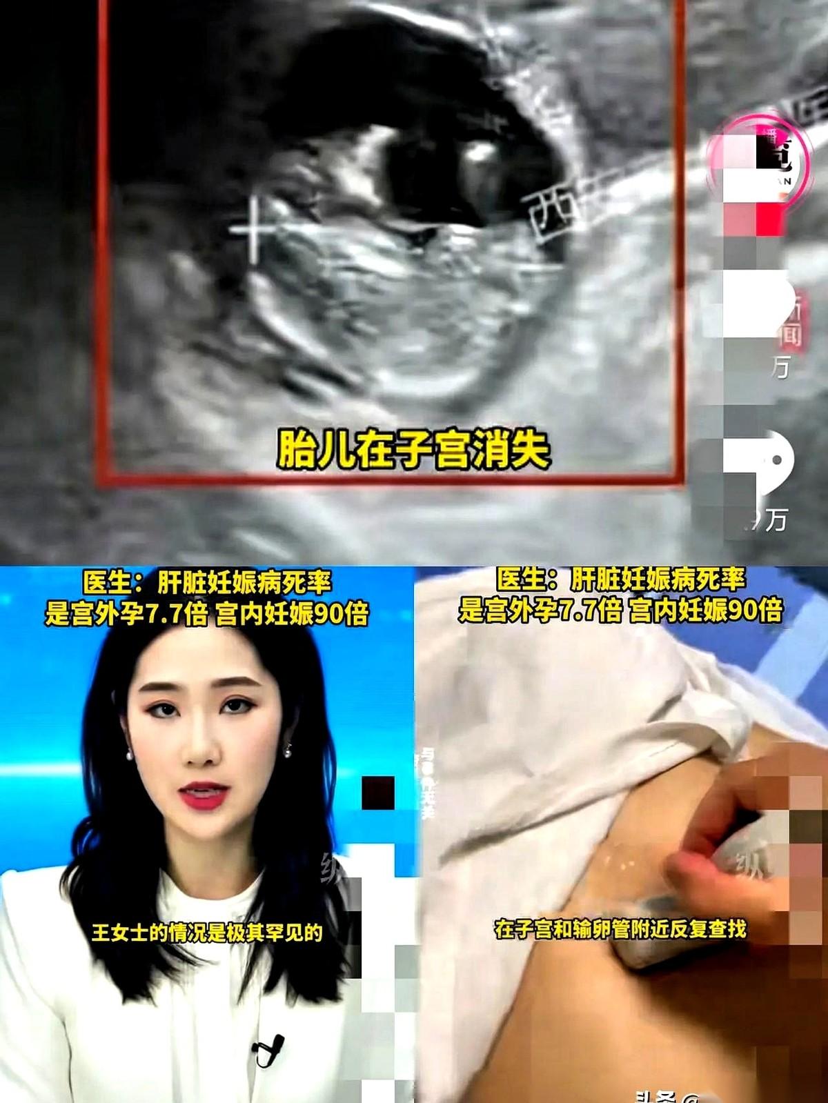 孩子怀在了肝上。你没听错，我也没说错，就是肝脏的肝。死亡率，是正常怀孕的90