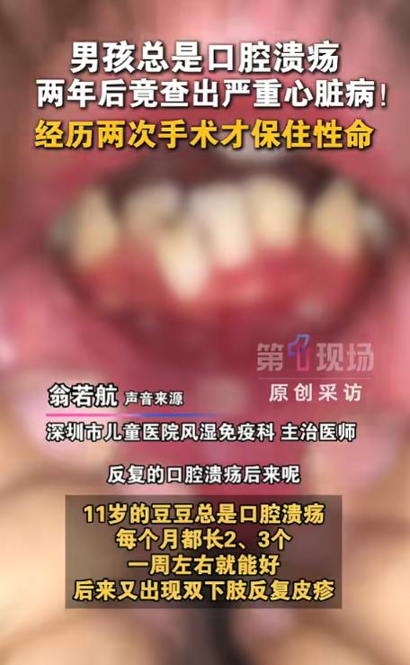 “万万没想到！”5月26日报道，广东深圳，一男孩频繁长口腔溃疡，嘴巴舌头轮番溃烂