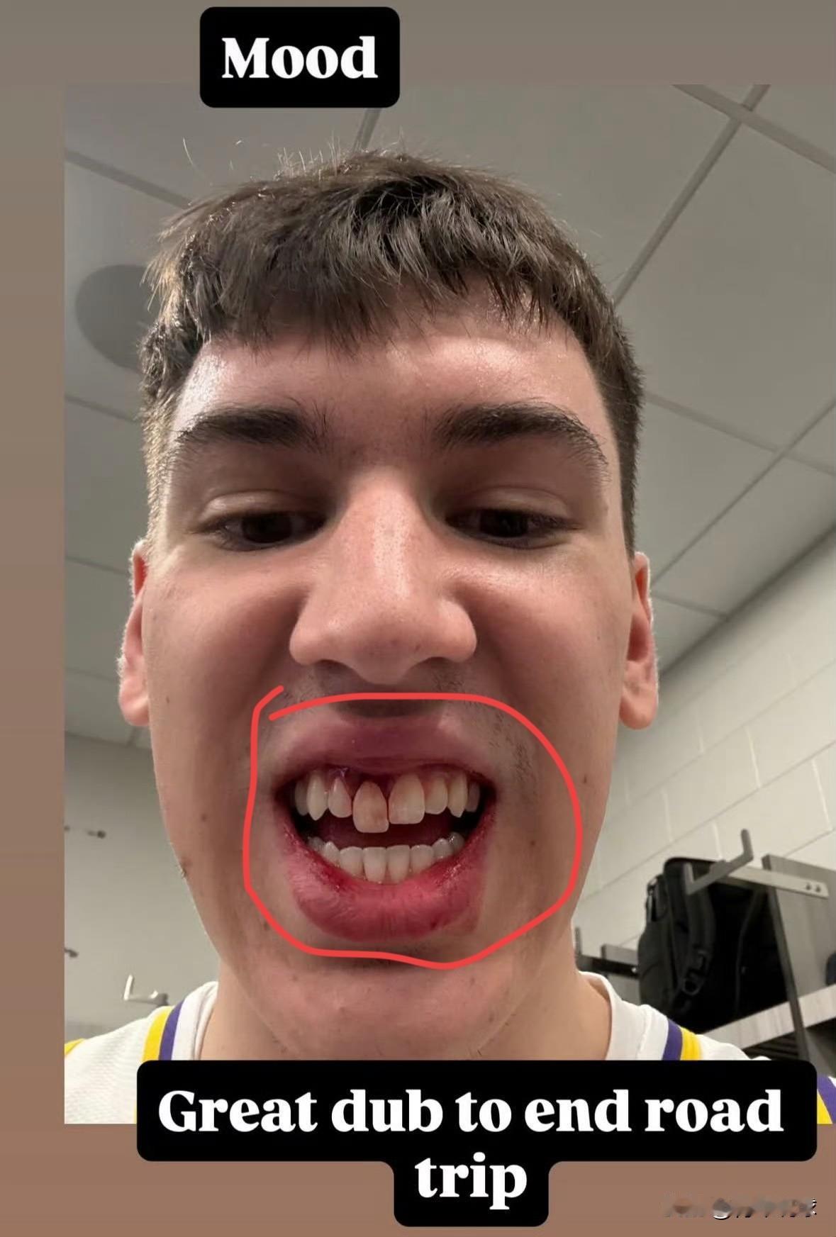 拉拉维亚说话要漏风了！赛后，湖人队球员拉拉维亚在社交媒体上晒出照片，照片中这