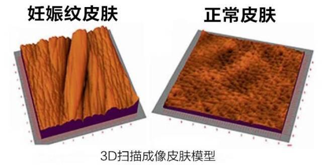 6个问题带你了解妊娠纹