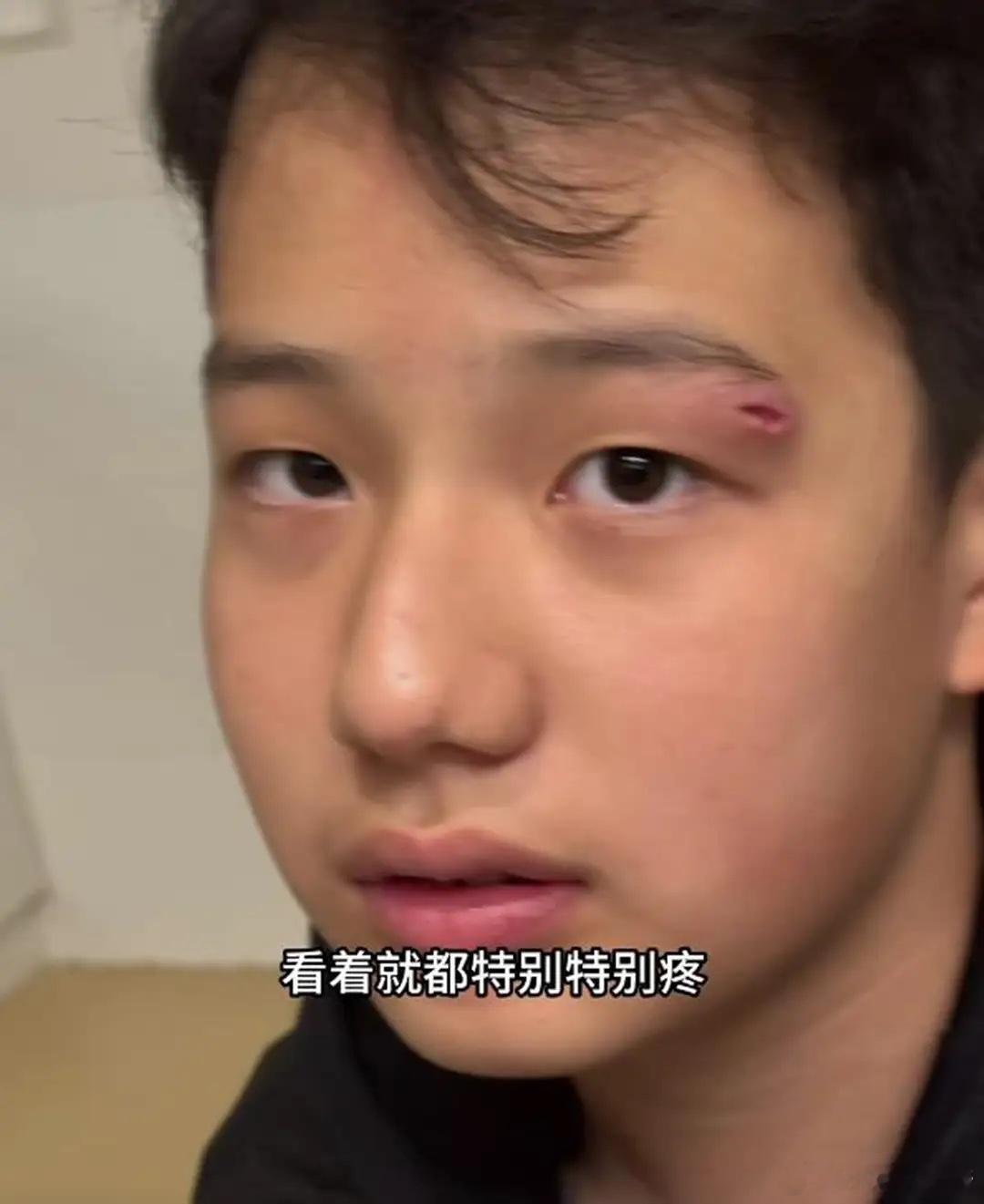 关凌13岁儿子眉尾长火疖子，用针挑破后变严重，到医院手术缝4针！