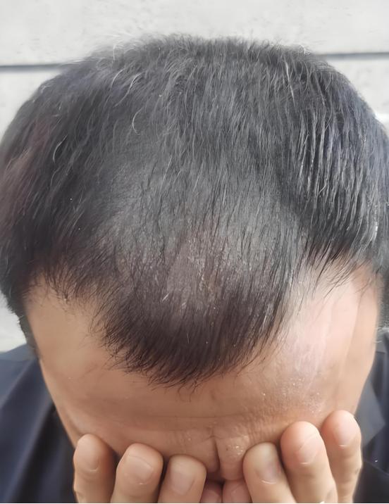 男性能活多久，看头发就知？若有这2异常，需要引起重视！ 生活中常能见到这样的