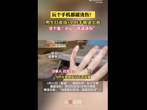 长沙男子沉迷手游，充电状态下连肝5小时王者荣耀。手机持续高温烘烤手指，他却因