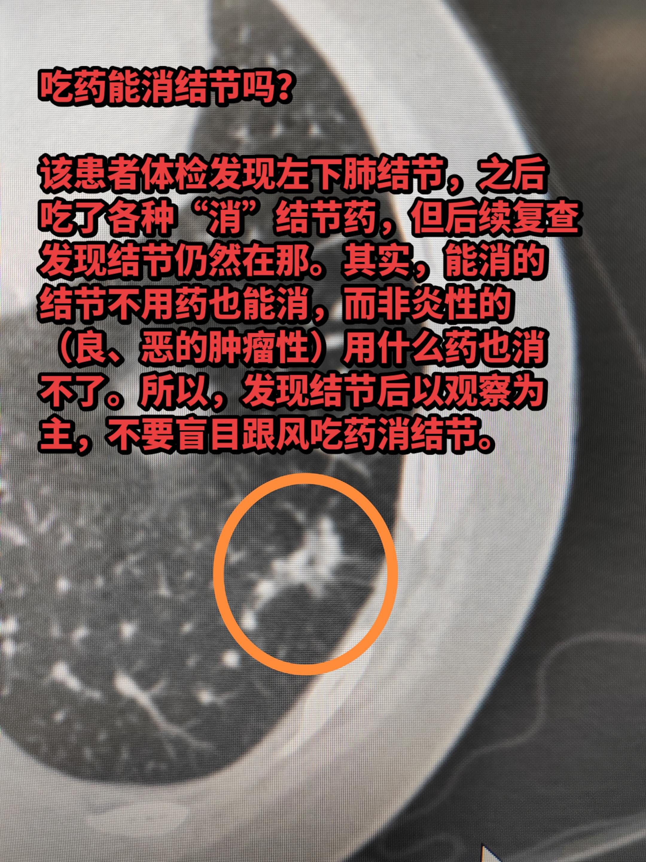 吃药能消结节吗？该患者体检发现左下肺结节，之后吃了各种“消”结节药，但...