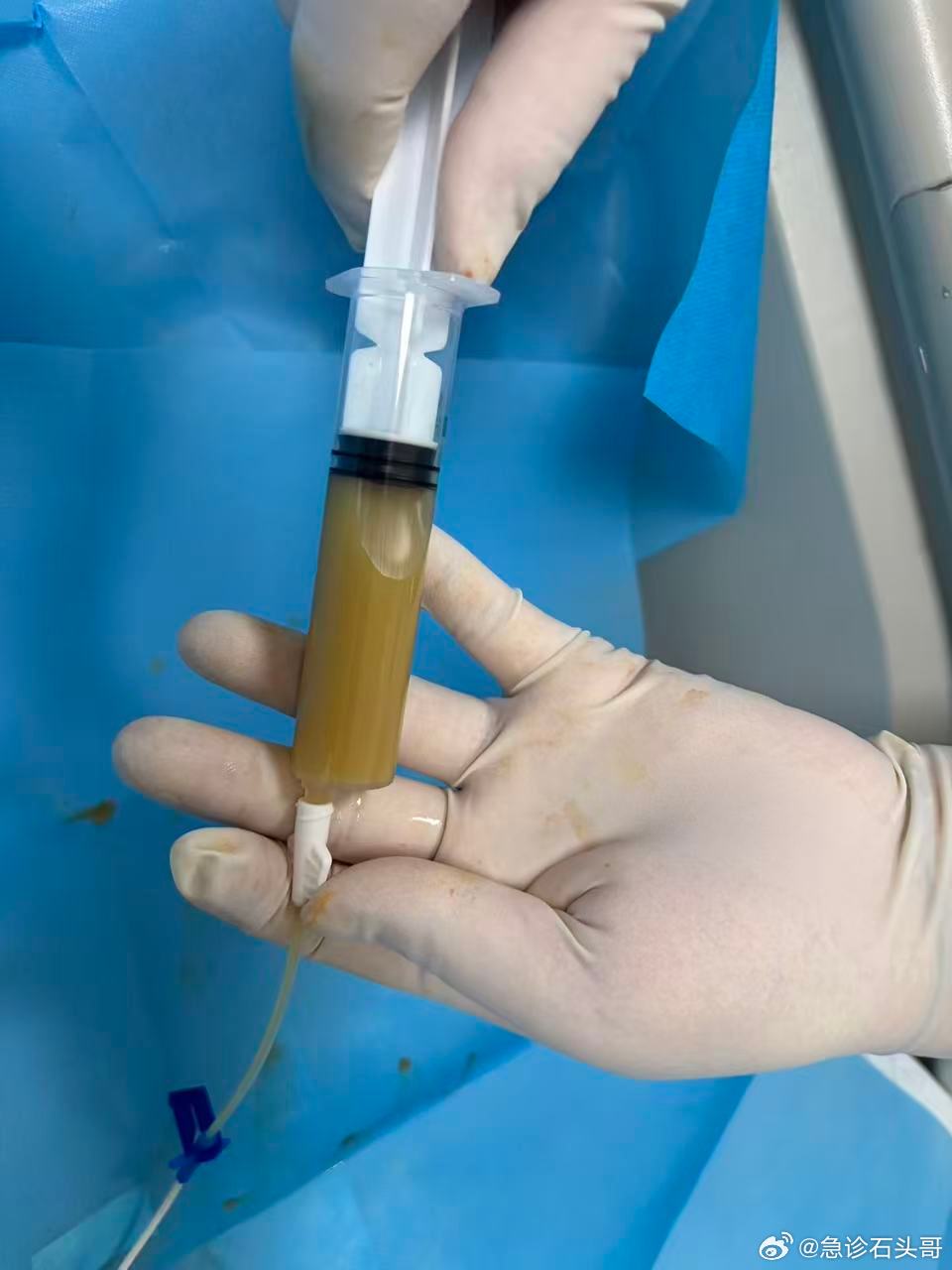 这是从患者肚子里面抽出来的脓，腹腔的感染，或者说腹腔里面的疾病，各种问...