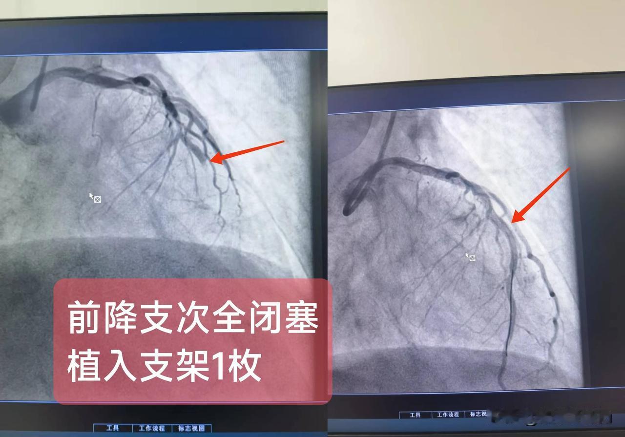 急性ST段抬高型心肌梗死（前降支次全闭塞)一.概念：左前降支走行于室间沟