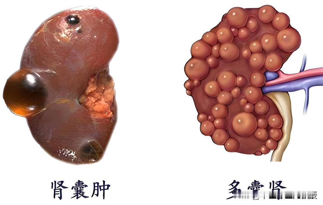 中医一个小方子，肾囊肿从胀闷到平复我祖父是个老中医，也是我们家里医术最顶尖的