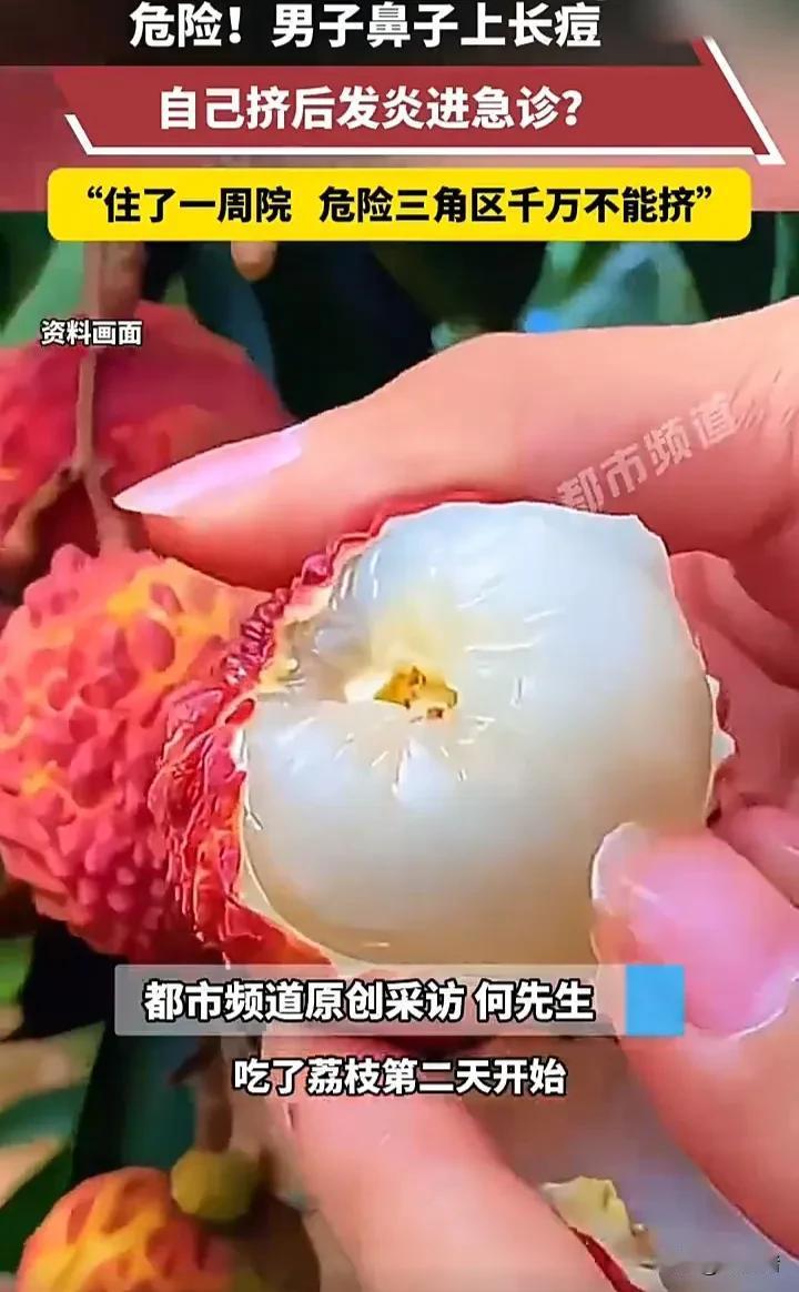 太悲催了！7月11日，广东一名男子吃完荔枝后第二天，鼻子开始长痘变得红肿，于是自