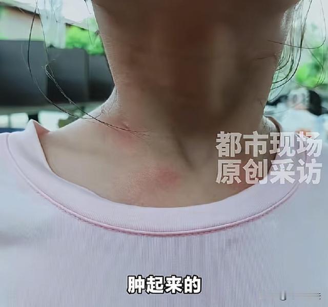 广东湛江，彭女士5岁孩子晚上突然过敏，脸和眼睛肿得厉害。她抱着孩子冲到医院，值班
