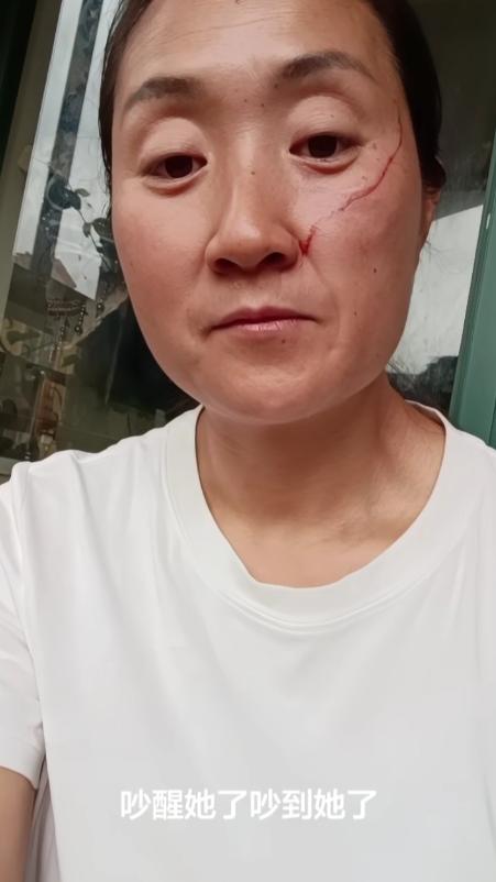 妈妈被高考完的女儿打破脸，原因是她中午做饭吵醒了女儿，女儿先是砸东西，妈妈说了她