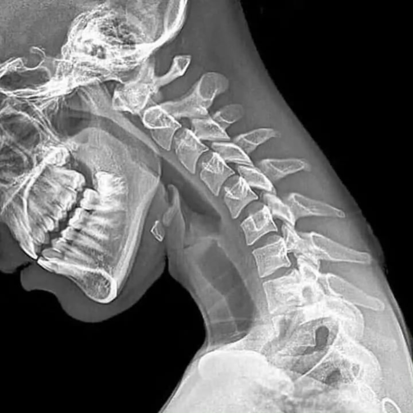 颈椎病假期结束，是不是又开始久坐低头了？——来看低头时，你颈椎的样子。——刷到