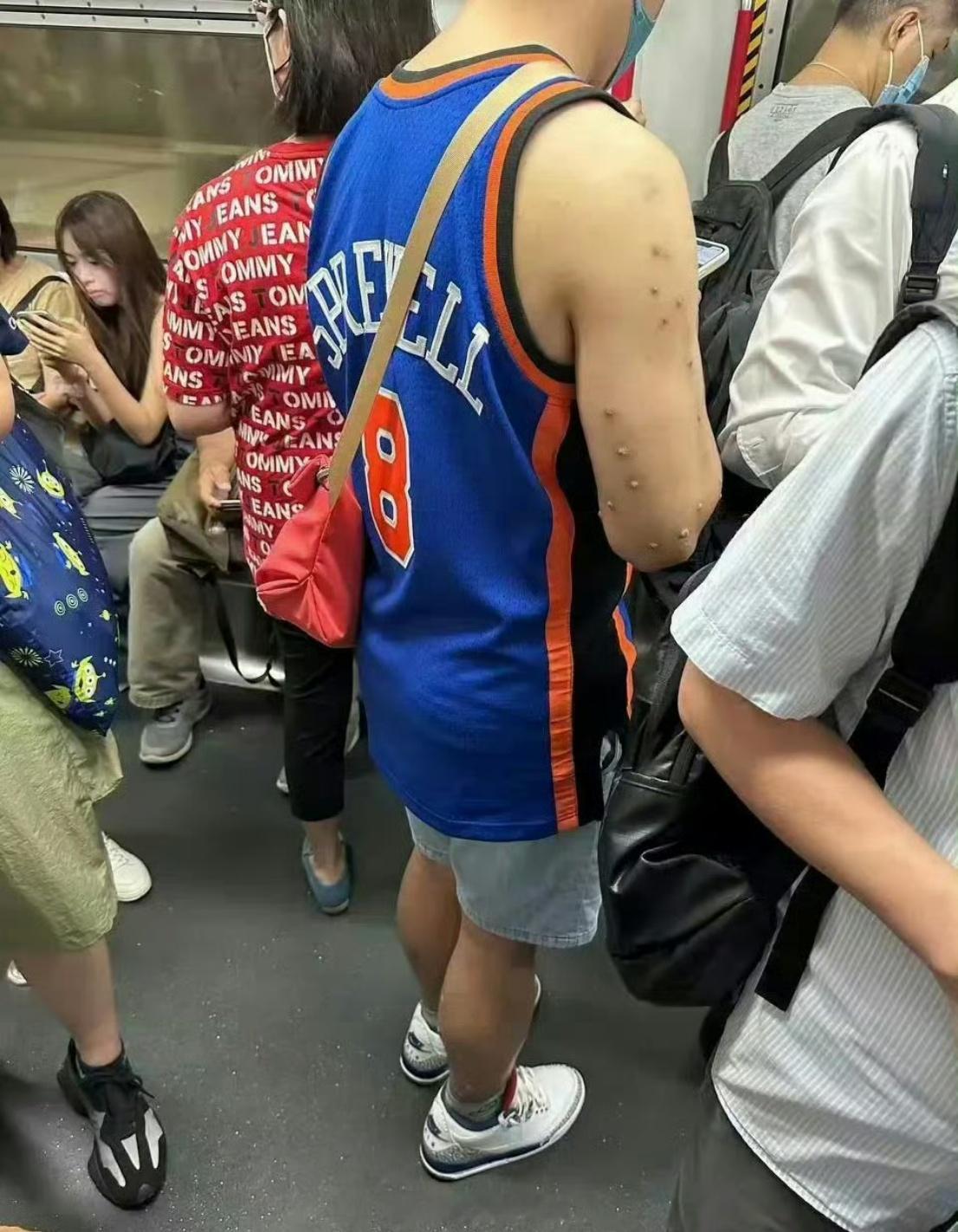 不懂就问，这算“猴痘”吗？
