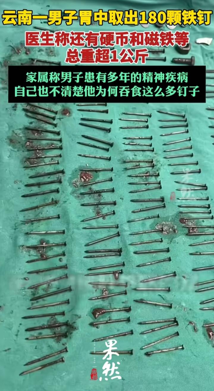 胃里取出180颗铁钉：别把异食癖当奇闻，它是藏在痛苦里的病看到这则新闻，我