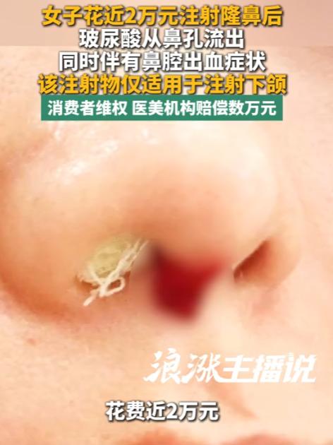 太吓人了！江苏一女子花近2万元注射隆鼻，术后感觉流鼻涕，伸手一擦竟是白色玻尿酸，