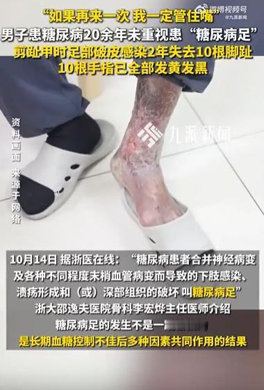 “可惜没有后悔药！”14日报道，浙江一男子剪脚指甲，不慎剪破拇趾边缘，出血并不多