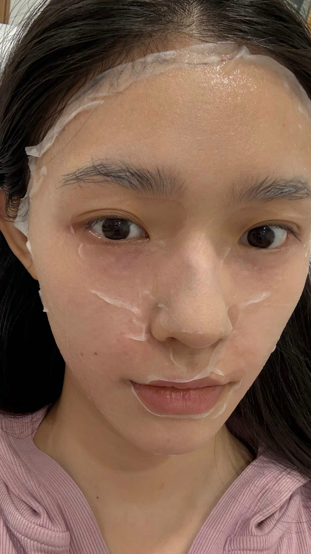 林允水光后的针眼挺吓人林允分享打水光针:每次护肤水光后的💉眼还挺吓人又是佩