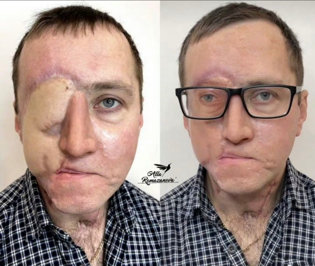 国外一男子因车祸失去一只眼睛，纹身师为其在眼眶处纹制“新眼睛”，看起来效果挺不