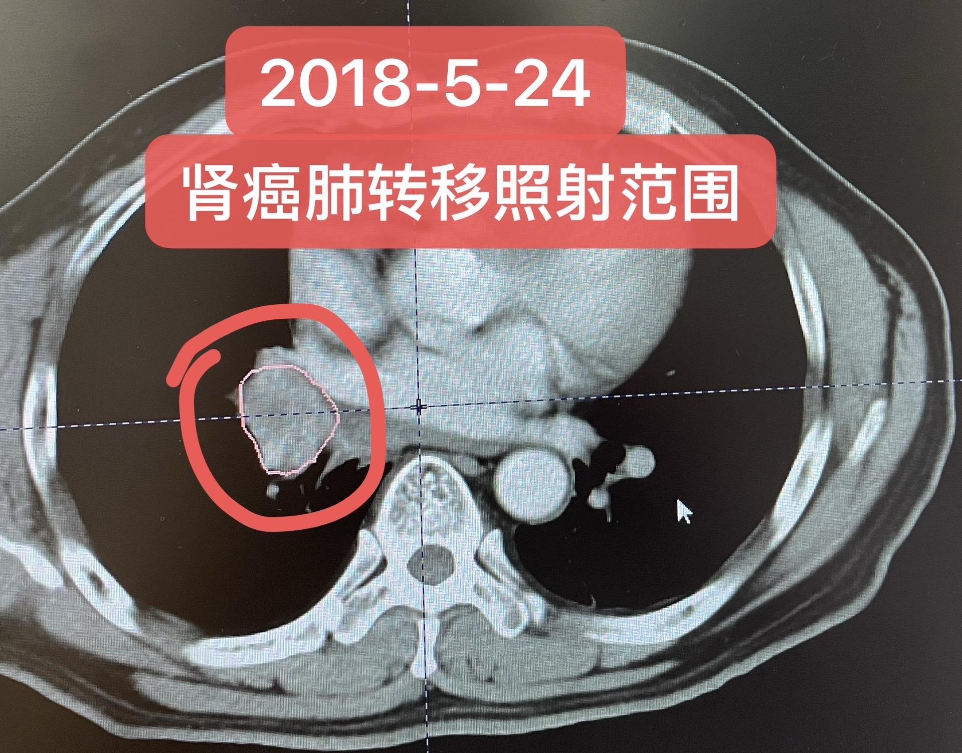 肾癌术后复发转移：带瘤生存12年仍稳定。患者男，患病时46岁！治疗流程...