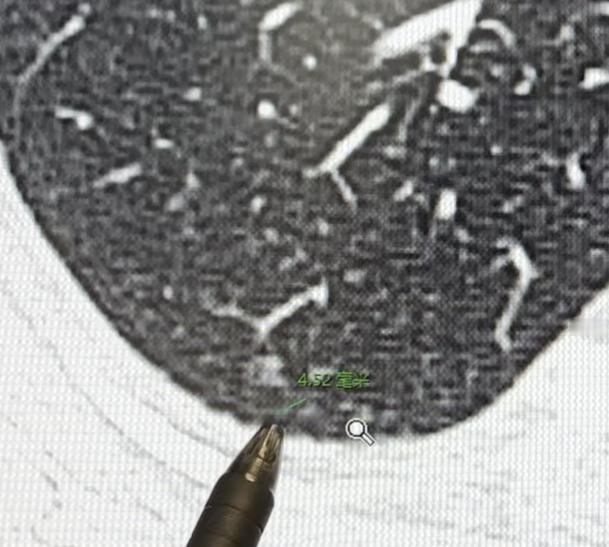 发现肺小结节后，最主要的措施就是定期复查、持续观察。很多朋友会问我：在观察期间，