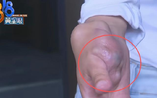 浙江杭州，山东德州的蔡女士为挣钱治右手血管瘤，辞去老家客服工作来杭州应聘。阿浩在