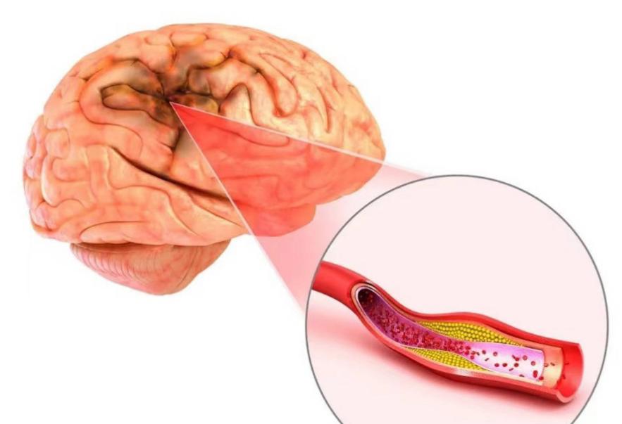 脑血栓致死人数逐年攀升！你知道吗？很多人每天吃的花生，竟可能悄悄推高血栓风险？这