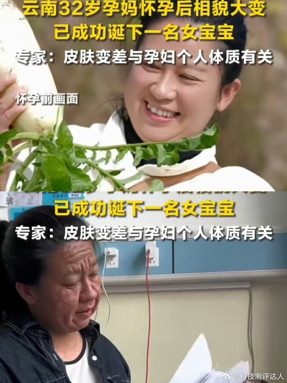 32岁孕妈怀孕后容貌变化明显恐生指南看到以后都不敢生了，这应该让那些男的看看，女