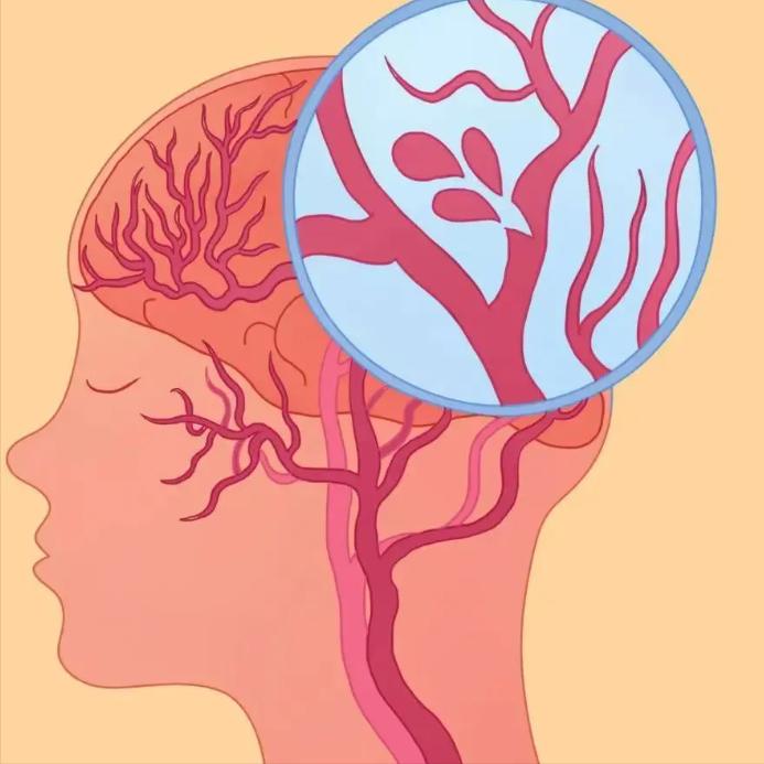 脑梗分级：绿灯能救，黄灯要抢，红灯最凶险！同样是脑梗，有人出院后照样上班，有