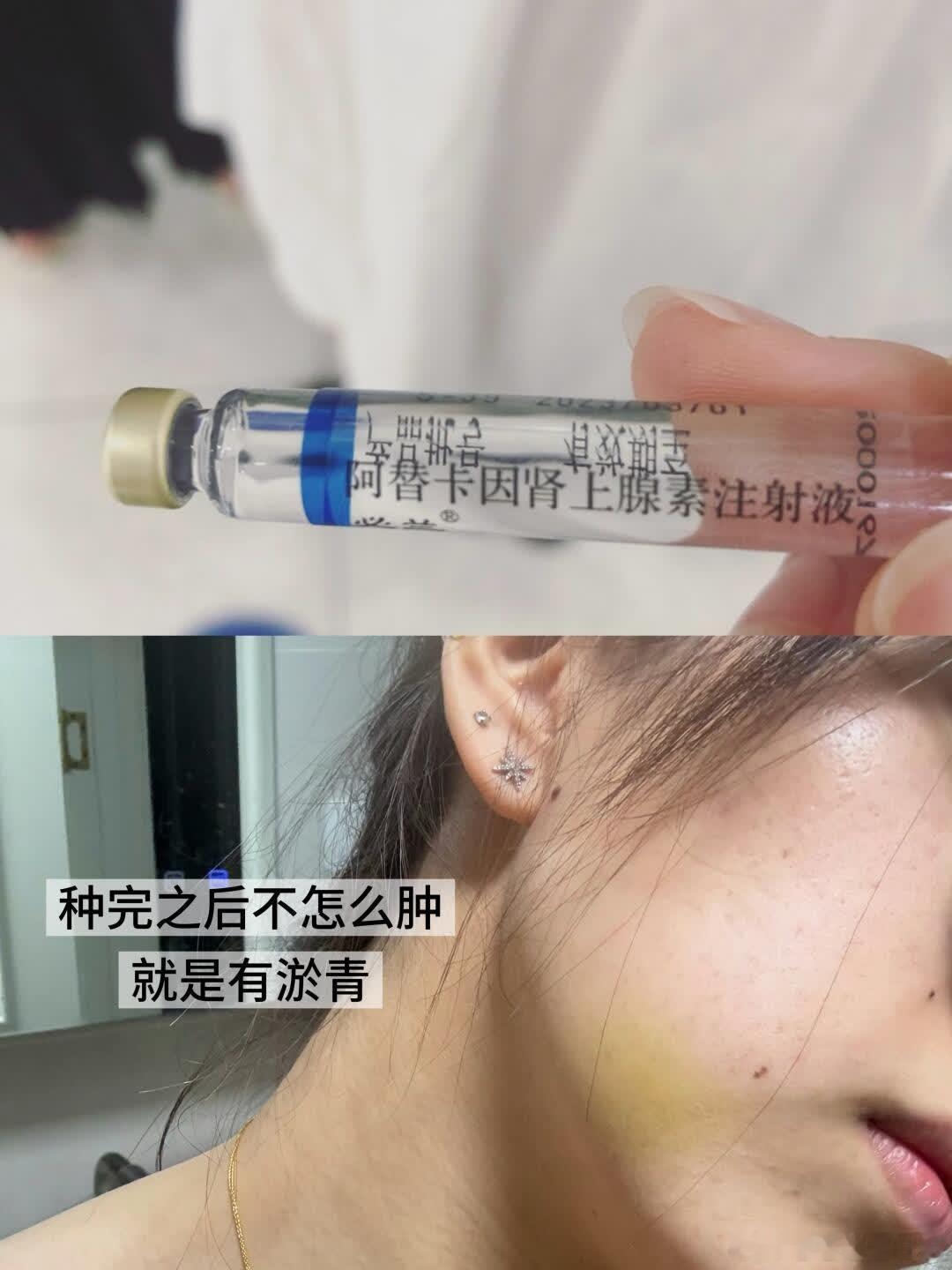 牙齿龋坏种2颗iti，由原华西口腔专家亲操从小?我的牙釉质就不好，两颗大牙先后