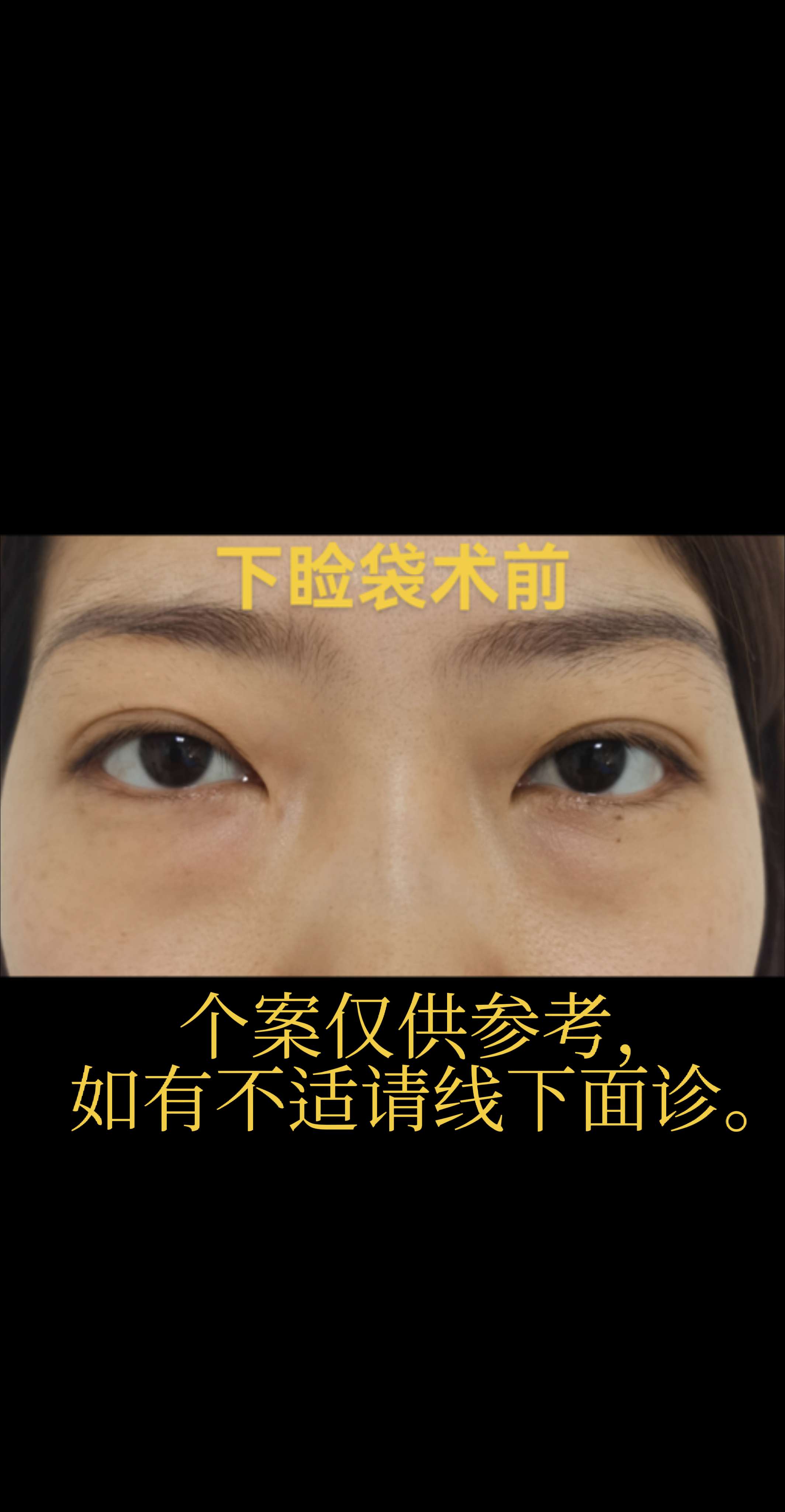 眼袋。
